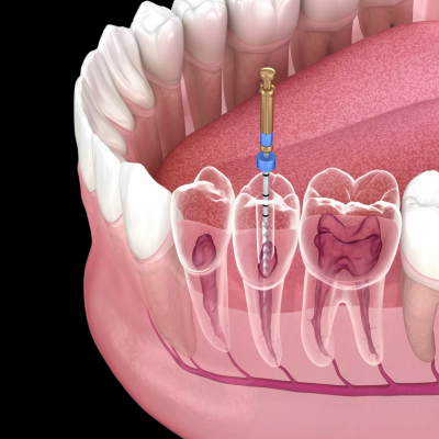 root canal